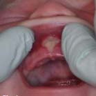Infant Frenum Release Post-Operative image 2